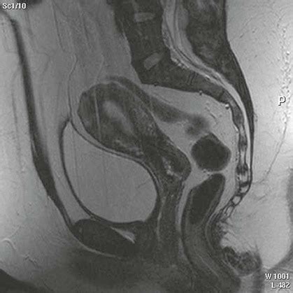 Magnetic resonance imaging of male and female genitals .